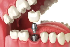 impianto dentale a Tirana / miglior clinica dentale albania
