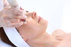 Does microneedling help with melasma?