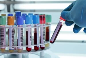 Avoid Crowds: Safe Blood Test at Home in Dubai