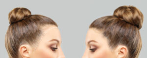 زراعة الشعر في الرياض