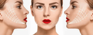 Best Thread Lift Doctor in Islamabad