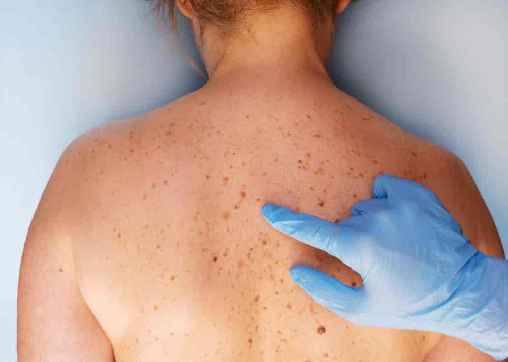 Can Birthmark Removal Treatment Remove All Types?