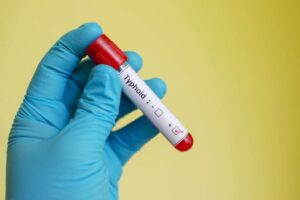 typhoid fever
