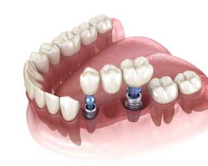 implant