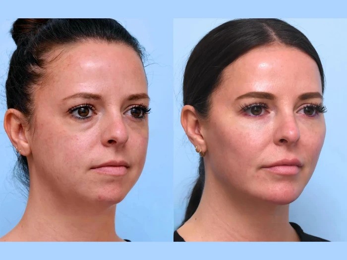 Achieve Firmness and Contours with Minimally Invasive Thread Lift Treatments in Dubai