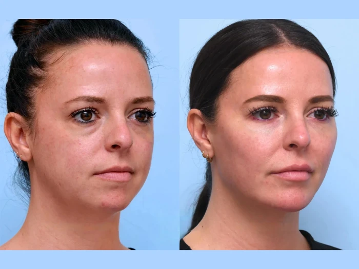 How Thread Lift in Dubai Can Lift and Tighten Your Skin Without Surgery
