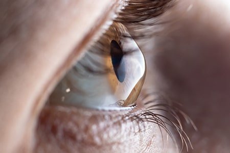 LASIK Eye Surgery London