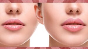 Lip Filler in Islamabad