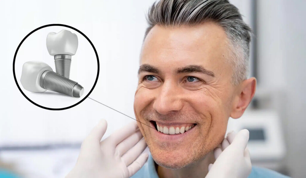 Dental Implants