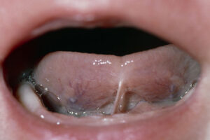 Tongue Tie Surgery