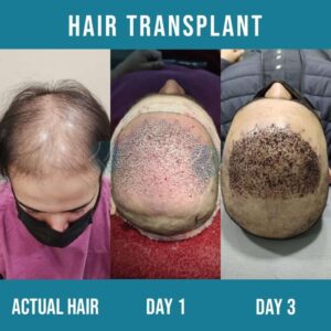 Hair Transplant