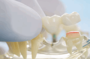 dental bridges louisville ky