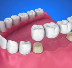 Dental Bridge Services