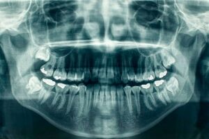 Panoramic Dental X-Ray Cost in Dubai