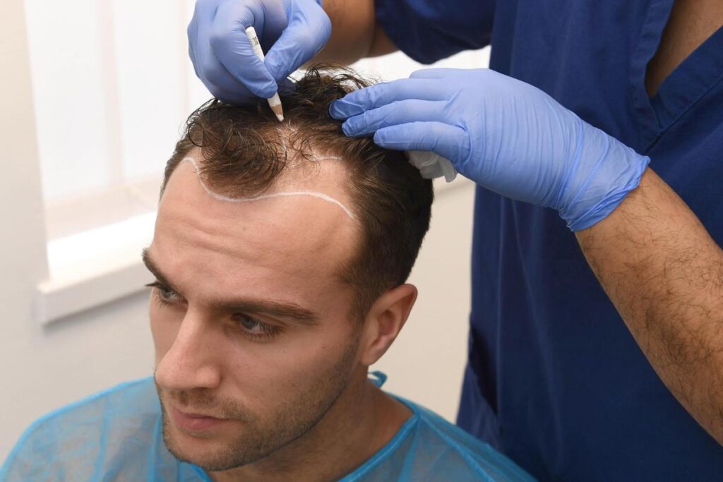 Hair Transplant