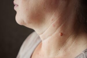 Skin Wart Removal Cost in Dubai