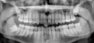 Panoramic Dental X-Ray Cost in Dubai