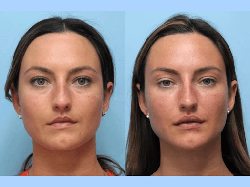 Thread Lift Treatments in Dubai for Sagging Jawlines
