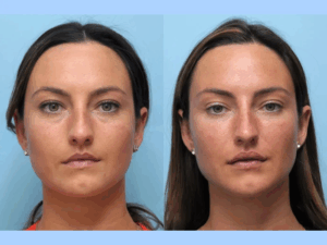 Face the Future with the Best Aesthetic Clinics in Dubai for Thread Lift