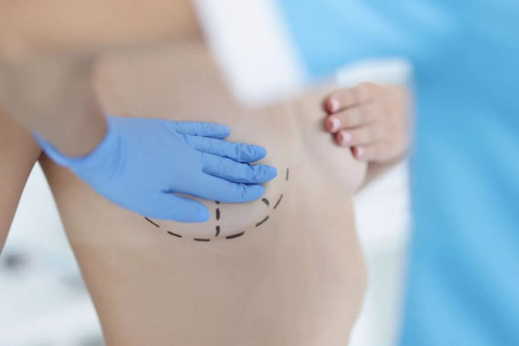 What Riyadh Women Should Know About Breast Reduction