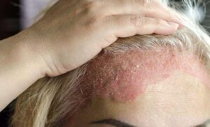 Can a dermatologist treat scalp eczema for good