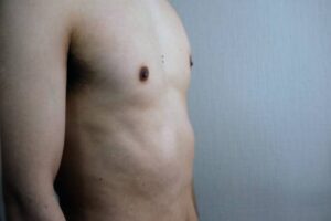 Preparation Guide for Gynecomastia Surgery in Riyadh