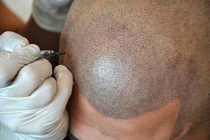 Latest Hair Transplant Technologies Available in Riyadh