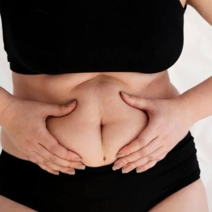 Liposuction in Riyadh