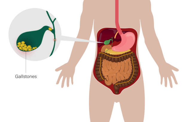 gallstones singapore