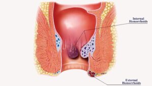 Lifestyle Tips for Hemorrhoid Relief in Riyadh