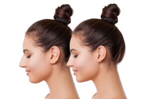 Rhinoplasty Price