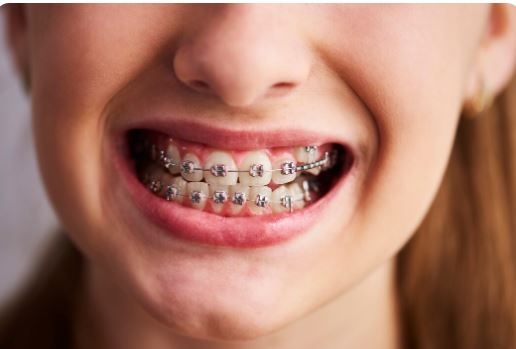 braces